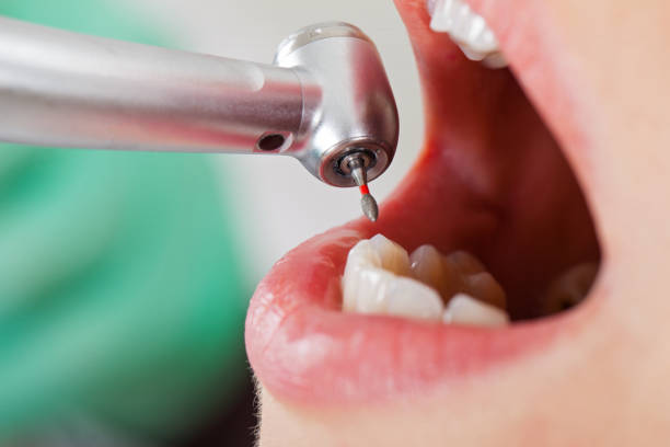 Best Emergency Wisdom Tooth Extraction in Bloomfield, MO